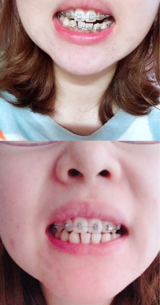 上下牙一起的照片纪念一下