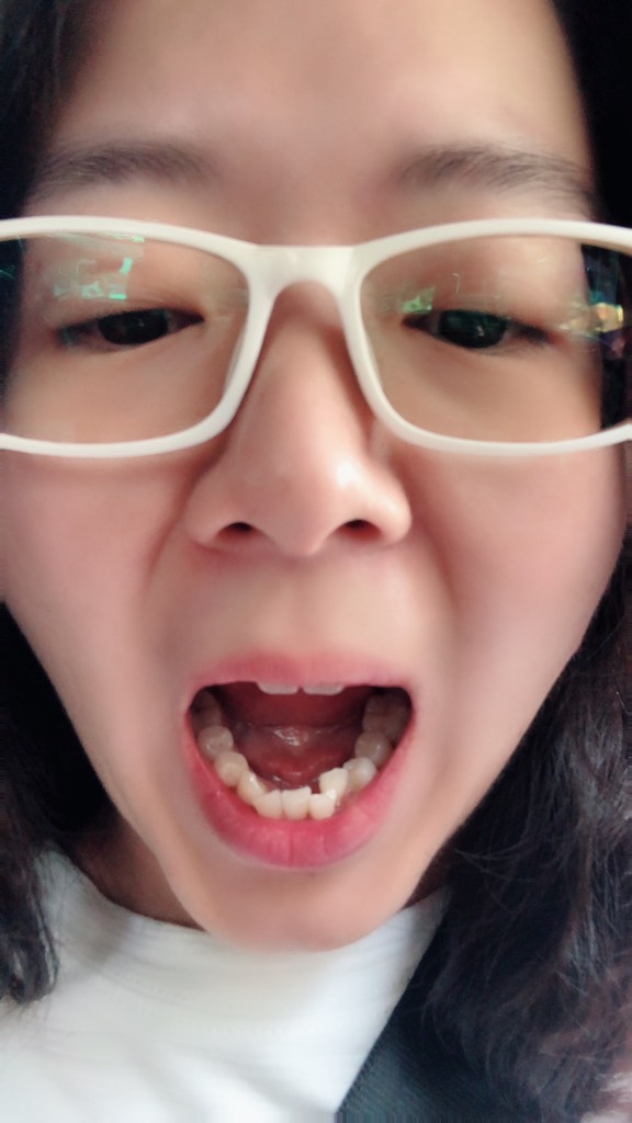 纪念矫正前的一口烂牙
