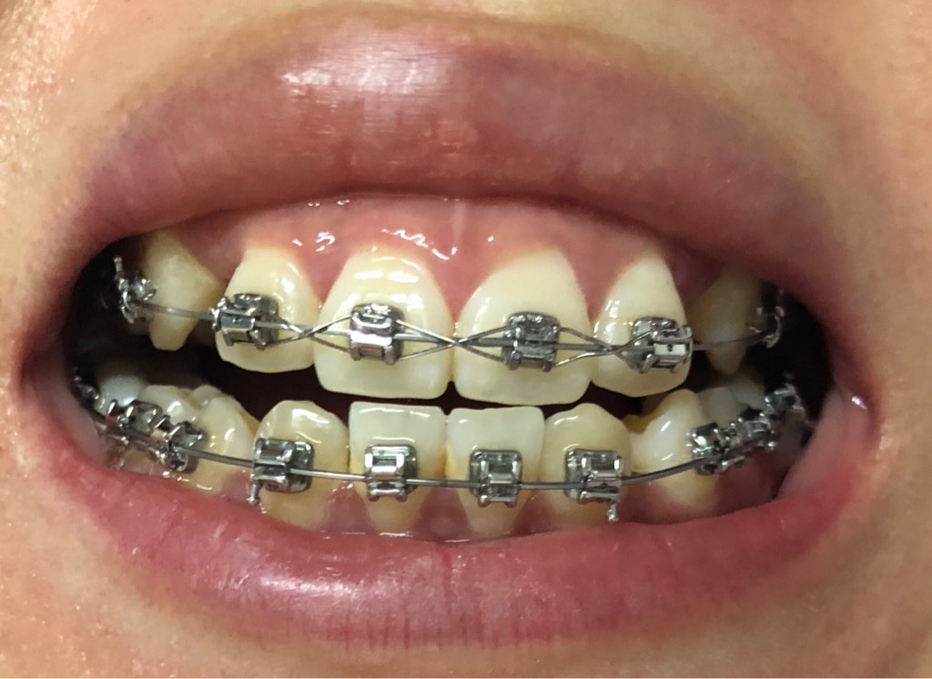 下面门牙旁有黄色的东西是什么?两个牙齿中间,刷牙也刷不掉